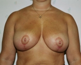 Feel Beautiful - Breast Reduction San Diego 6 - After Photo